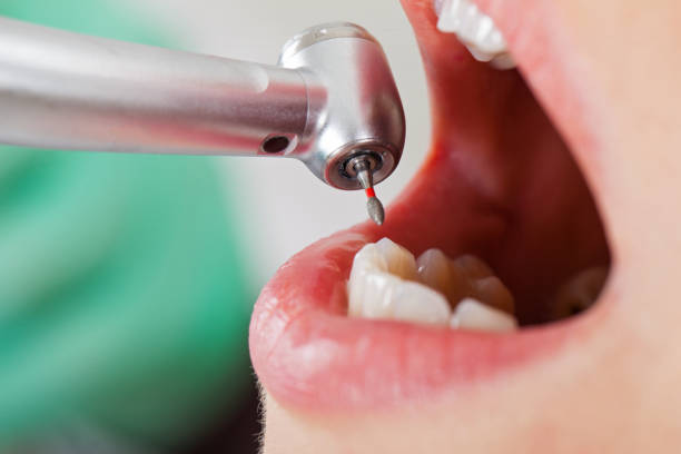 Best Emergency Wisdom Teeth Removal in Solon, IA